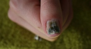 Plak Nagels